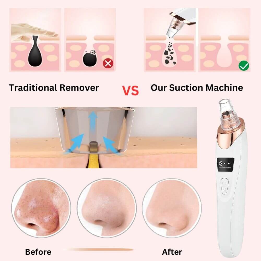 blackhead remover tool - powerful blackhead and grease removal